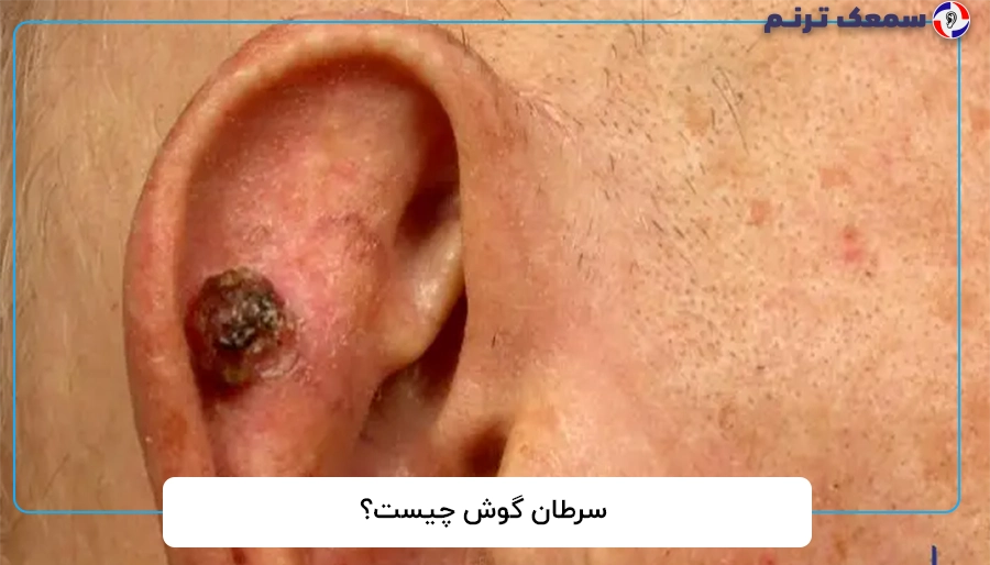 سرطان گوش چیست؟