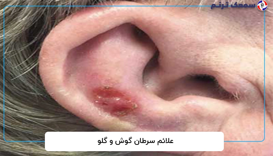 علائم سرطان گوش و گلو