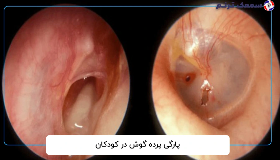 پارگی پرده گوش در کودکان